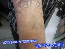 Tattoo Removal NYC after